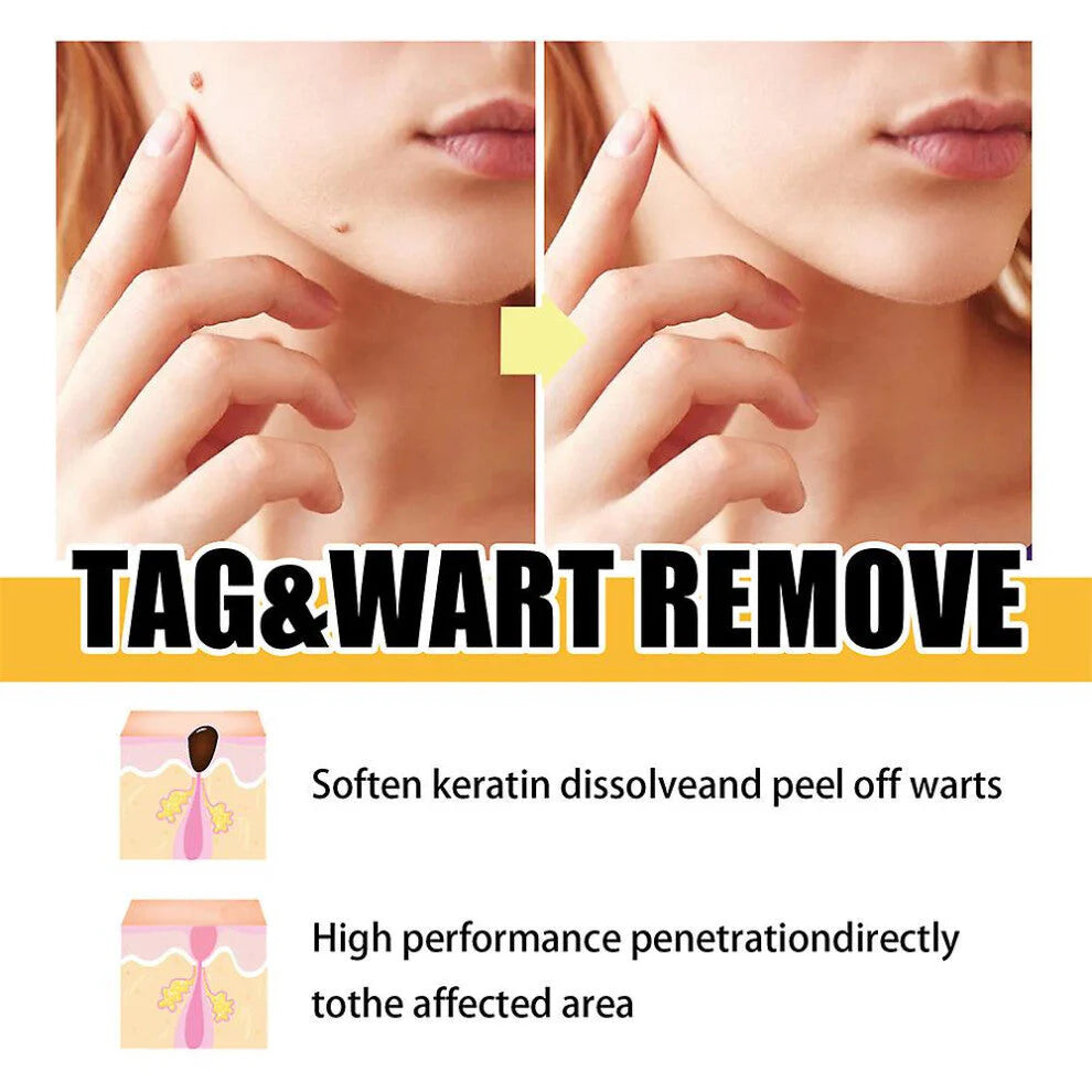 Mistfall PureSkin Tag & Mole Remover