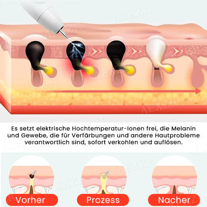 Mistfall DermaBeam Laser Pen