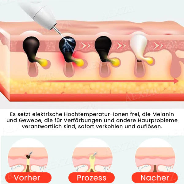 Mistfall DermaBeam Laser Pen