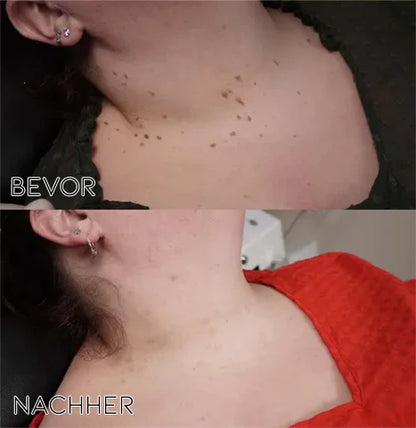 Mistfall PureSkin Tag & Mole Remover