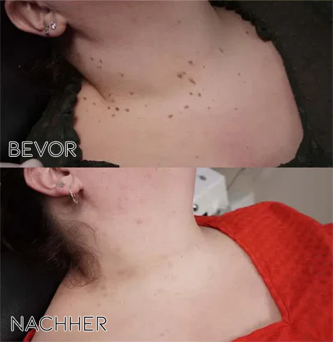 Mistfall PureSkin Tag & Mole Remover